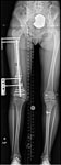 Case 74: Nicole postop- Femur lengthening and bowleg deformity correction