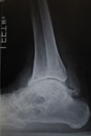 Limb Lengthening Case 75 followup: Ankle distraction for treatment of post-traumatic arthritis