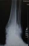 Limb Lengthening Case 75 followup: Ankle distraction for treatment of post-traumatic arthritis