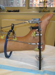 Limb Lengthening Case 75 postop: Ankle distraction for treatment of post-traumatic arthritis