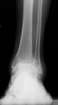 Limb Lengthening Case 75 preop: Ankle distraction for treatment of post-traumatic arthritis