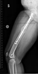 Limb Lengthening case 76, post op Femur lengthening with the Precice Internal Lengthening Nail