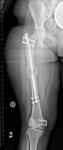 Limb Lengthening case 76, post op Femur lengthening with the Precice Internal Lengthening Nail