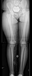 Limb lengthening case 76 preop Femur lengthening with the Precice Internal Lengthening Nail