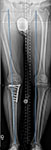 Follow up X-ray of Richard's legs