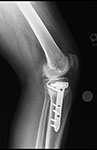 Follow up X-ray of Richard's right knee