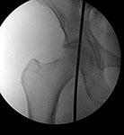 Post-op X-ray of Richard's knee