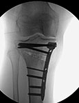 Post-op X-ray of Richard's knee