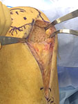 Image indicating microfracture technique during surgery