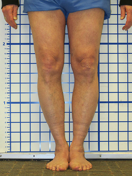 Knee Realignment & Joint Preservation: Prox Tibial Osteotomy
