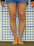 Pre-op photo of Richard's legs