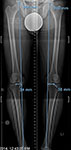 Pre-op X-ray of Richard's legs