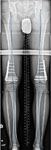 Follow-up X-ray of Yang's legs