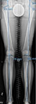 X-ray image of Yang's legs