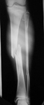 Tzvi, Pre-op thumbnail of an X-ray, Limb Lengthening, Ski Accident, fractured tibia, compartment syndrome, emergency faciotomy