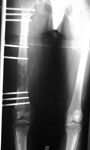 John, followup Image, Bone transport in femur for a 10 cm defect