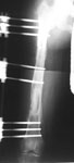 LL case9: John, followup Image, Bone transport in femur for a 10 cm defect