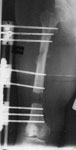 John, post-op Image, Bone transport in femur for a 10 cm defect
