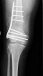 limb lengthening case 77 follow up