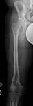 limb lengthening case 77 follow up