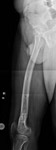 limb lengthening case 77 follow up