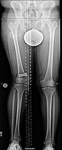 limb lengthening case 77 preop