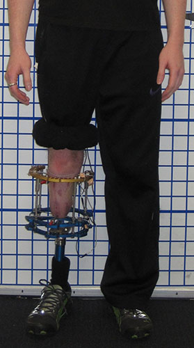 Lengthening Below-Knee Amputation to Enhance Prosthetic Wear