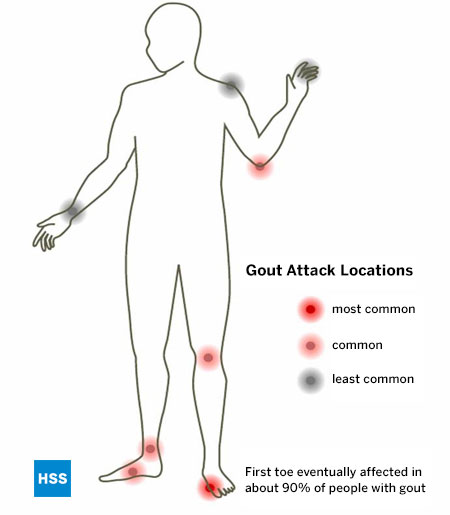 Ilustrasi tubuh manusia yang menunjukkan lokasi umum untuk gout, dengan lokasi serangan gout di tubuh yang diberi label kesamaan, dengan jempol kaki paling umum, sendi kaki tengah dan lutut paling umum, dan sendi pergelangan tangan dan bahu paling jarang, dan perhatikan bahwa jari kaki pertama (jempol) akhirnya terpengaruh pada sekitar 90% orang dengan gout.