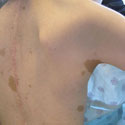 Image of a patient with Neurofibromatosis