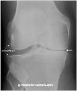 Image: anteroposterior (front to back) X-ray showing moderate osteoarthritis of the knee