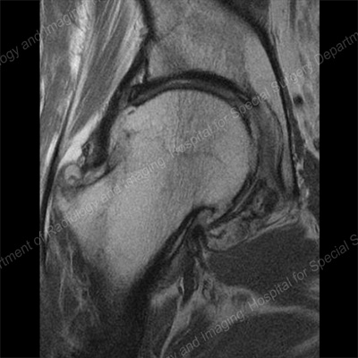 RM del plano coronal de la cadera demostrando osteoartritis