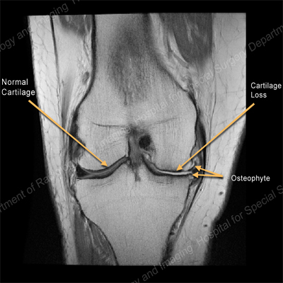 X-ray image showing normal cartilage in a knee at left and damaged cartilage and an osteophyte in a knee at right.
