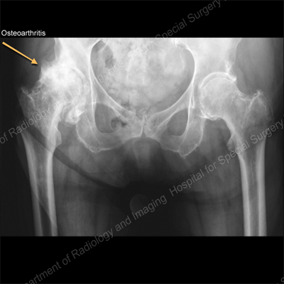 Artrosis y estrechamiento grave del espacio articular con osteofitos x-rayo