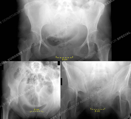 X-rays of the pelvis showing anteroposterior, inlet, and outlet views 