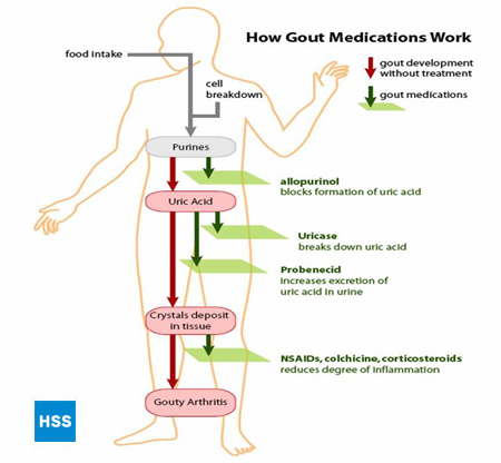 Gout / Gouty Arthritis | Symptoms, Diagnosis and Treatment | HSS