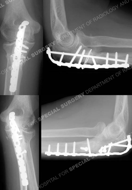 radiographs at 12 months healed monteggia fracture-dislocations from a case example presented by the orthopedic trauma service at Hospital for Special Surgery