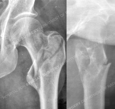 Anteroposterior and lateral radiographs revealing an unstable intertrochateric fracture from a case example from the orthopedic trauma service at Hospital for Special Surgery.