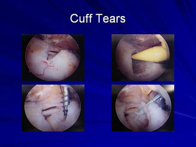 Image of rotator cuff tears