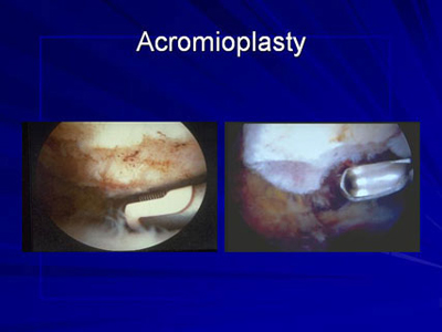 Image of acromioplasty