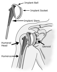 Anatomi av skulderområdet, som viser implantatet etter kirurgi, merket for å vise implantatkule, implantatkontakt, implantatstamme, humerus, humeralhode og glenoid.