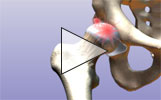 Image - Total hip replacement
