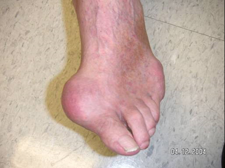 What Is Gout In Foot