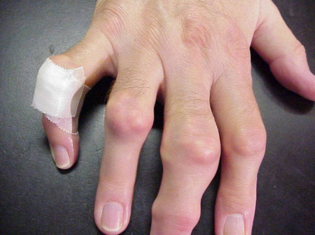 Foto che mostra tofi su mani