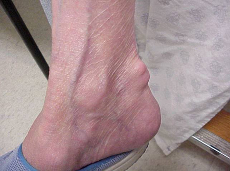 What does gout feel like?