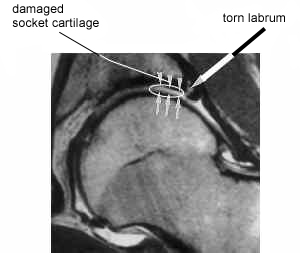 MRI of a hip with a torn labrum from an article about Femoroacetabular Impingement