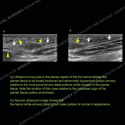 Image - Ultrasound of the Month Case 58 thumbnail