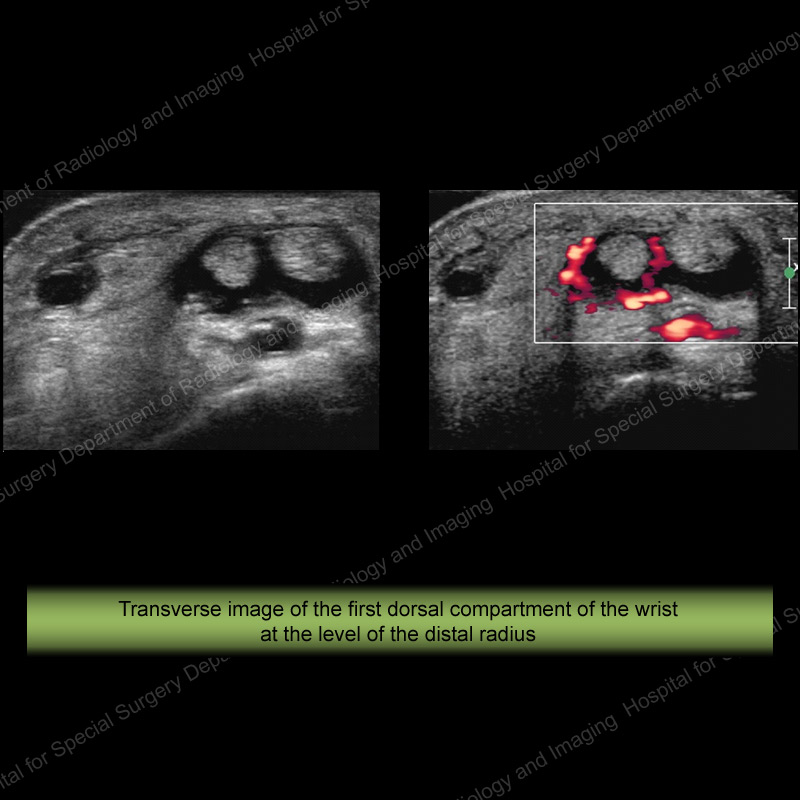 Ultrasound of the Month Case 5 - Transverse image of the first dorsal compartment of the wrist at the level of the distal radius