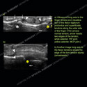 Image - Ultrasound of the Month Case 65 thumbnail