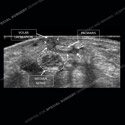 Image - Ultrasound of the Month Case 70 thumbnail
