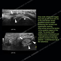 Image - Ultrasound of the Month Case 71 thumbnail
